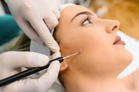 Mole Removal Long-Term Results and Effectiveness